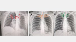 Como Avaliar a Qualidade da Radiografia do Tórax